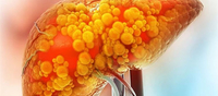 Just like alcohol, these 5 foods are as toxic for the liver